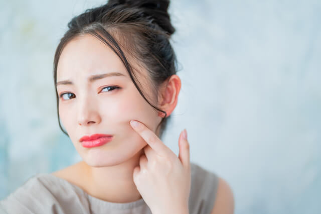頬にできたニキビを気にする女性